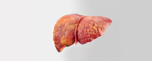 Safeguards from Non- Alcoholic Fatty Liver